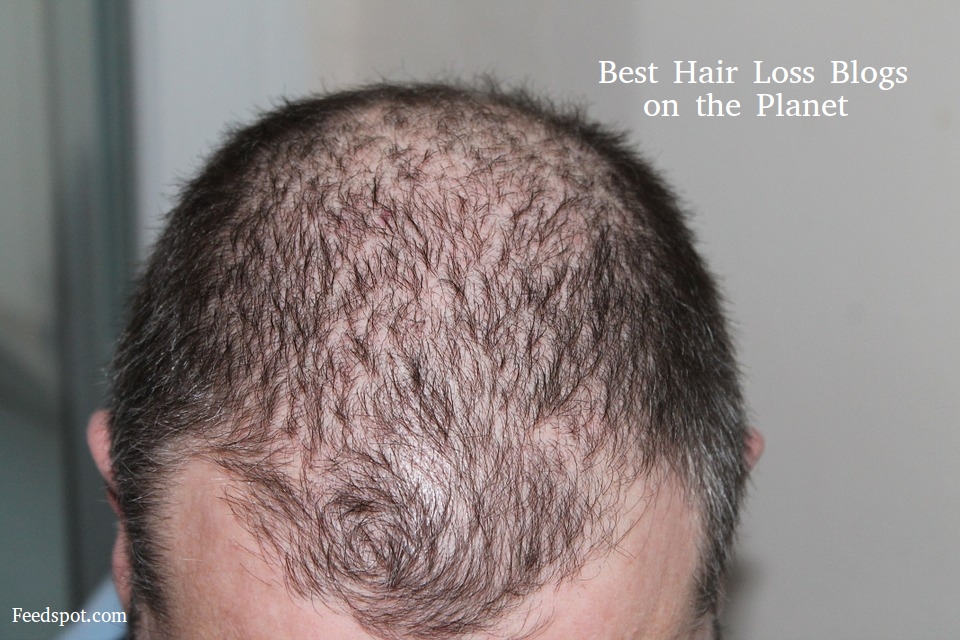 50 Best Hair Loss Blogs and Websites To Follow in 2023