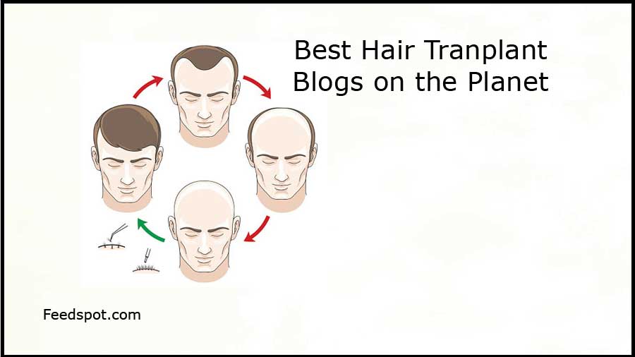 70 Best Hair Transplant Blogs and Websites in 2023