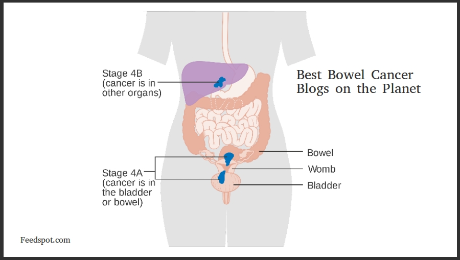 cancer colon blog)