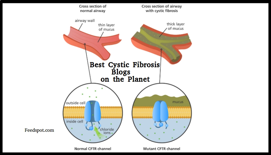 Cystic Fibrosis Life Expectancy Chart 2011